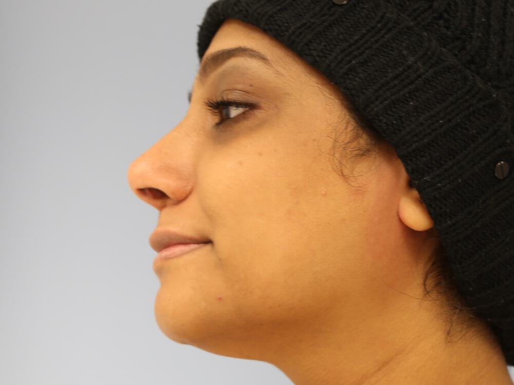 Revision Rhinoplasty Before & After Image