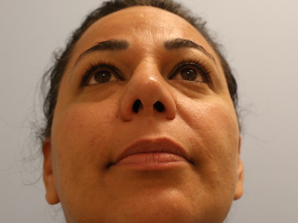 Revision rhinoplasty Before & After Image