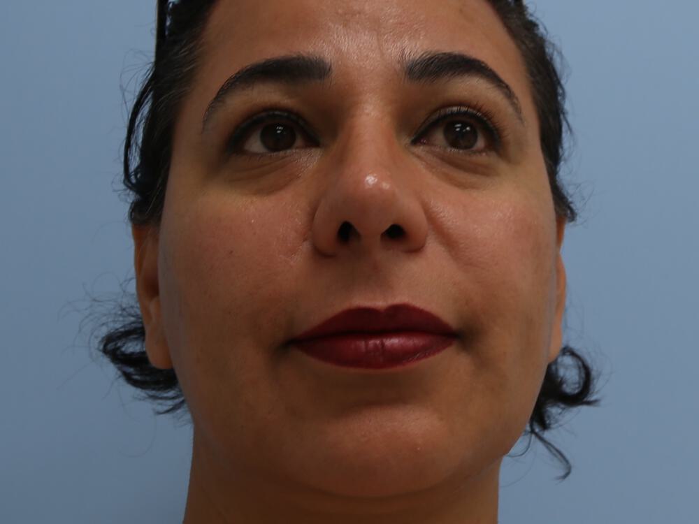 Revision rhinoplasty Before & After Image