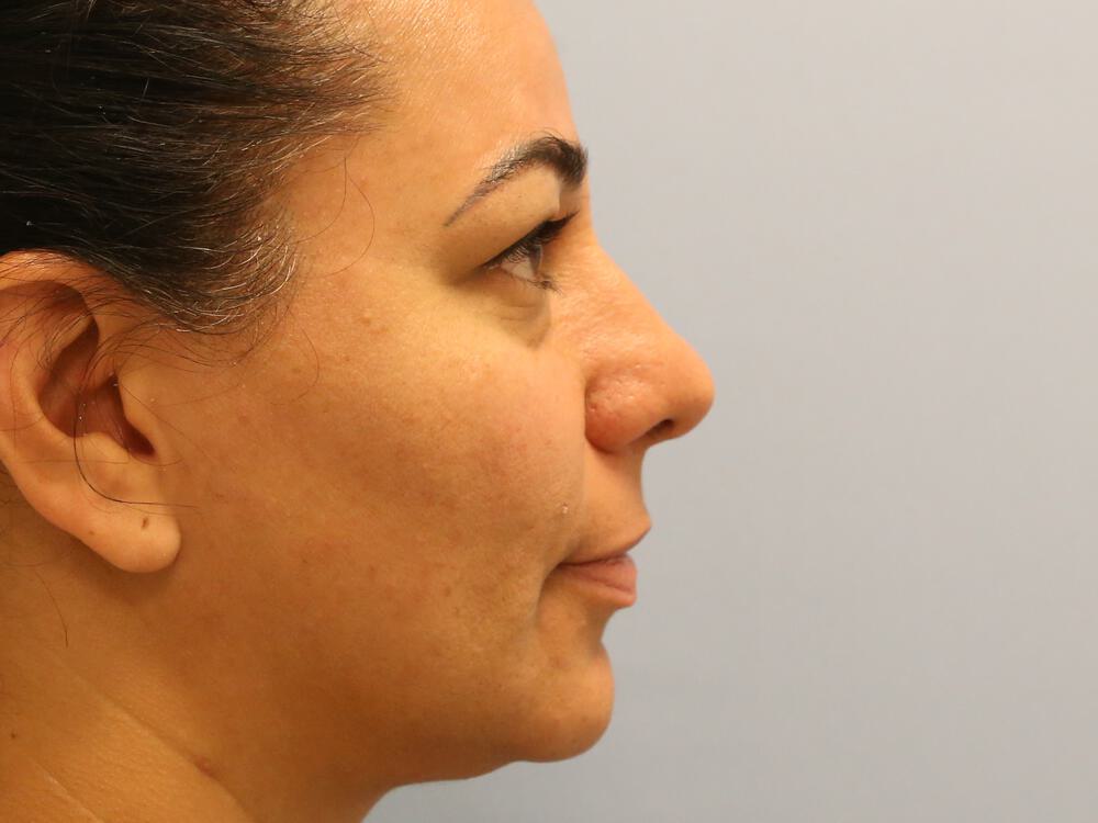 Revision rhinoplasty Before & After Image