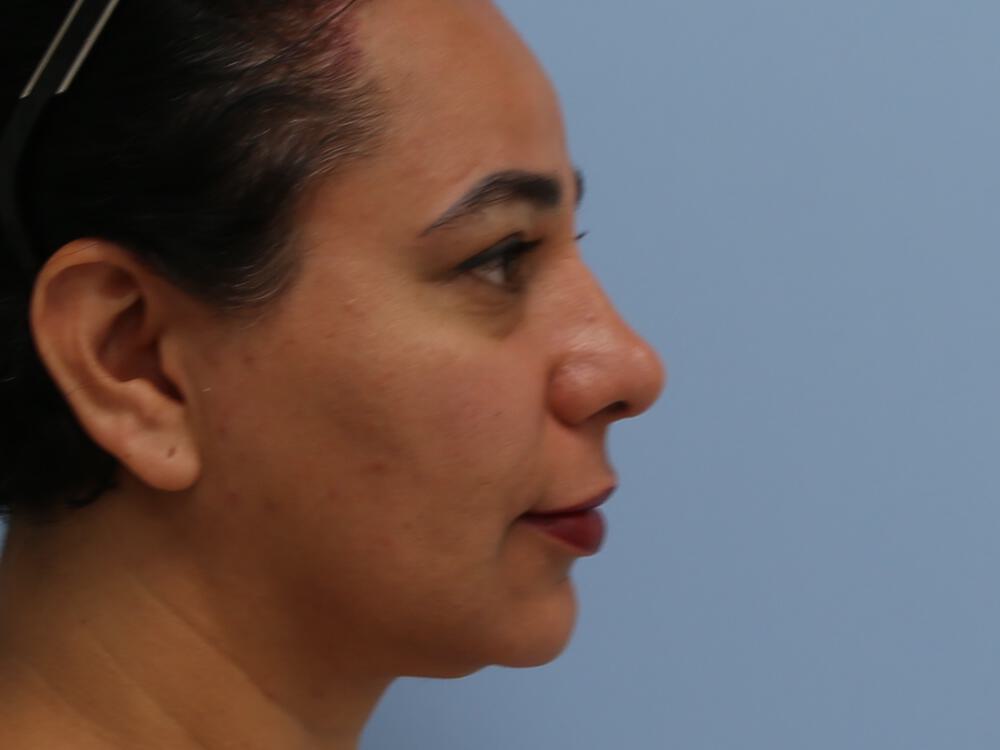 Revision rhinoplasty Before & After Image