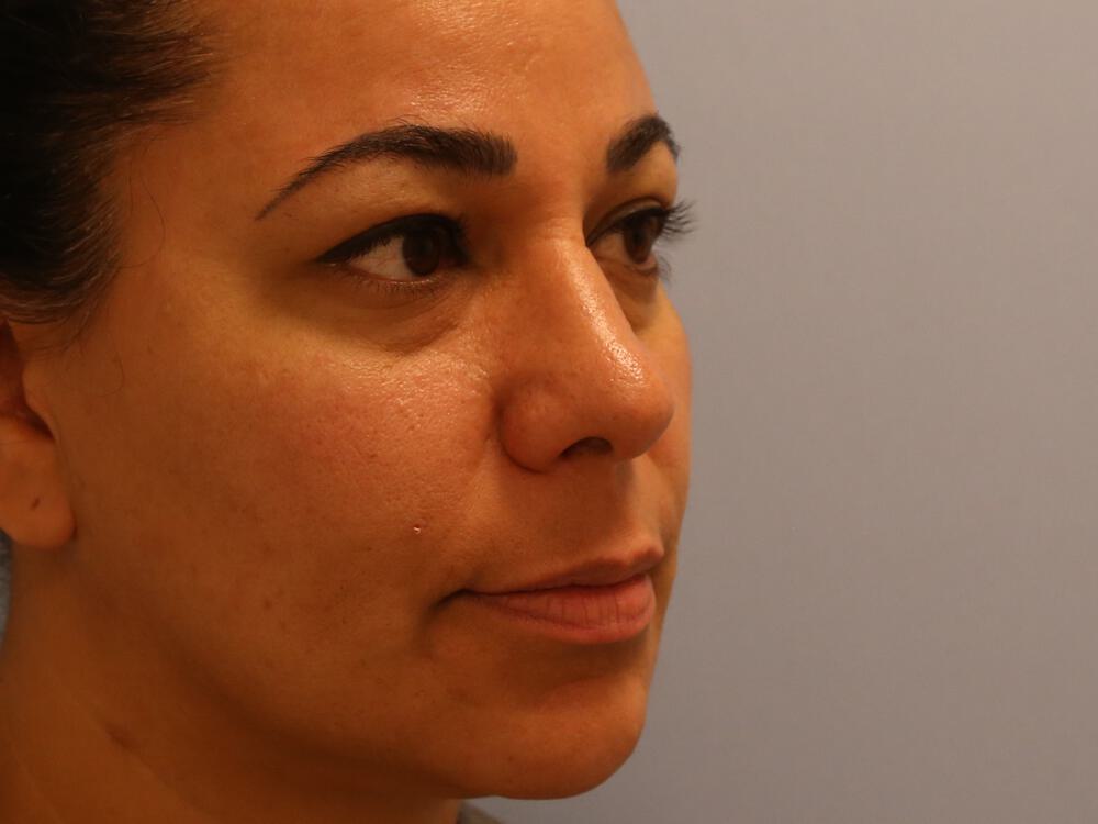 Revision Rhinoplasty Before & After Image