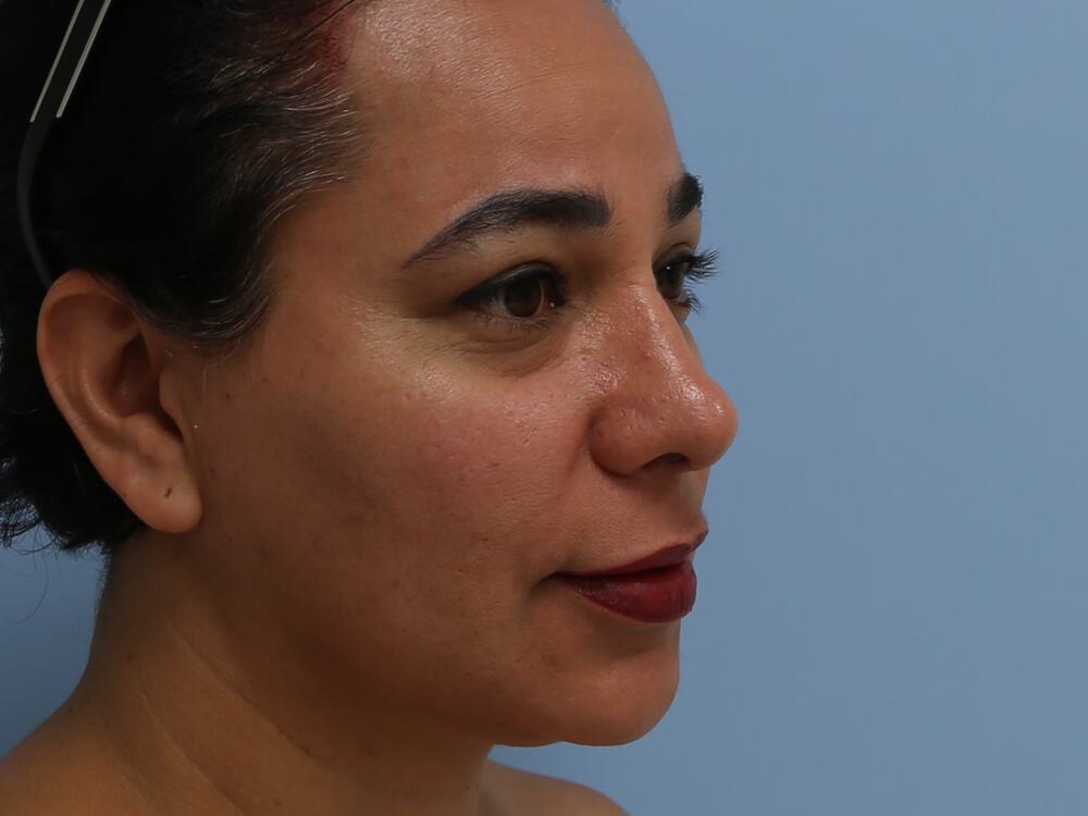 Revision Rhinoplasty Before & After Image