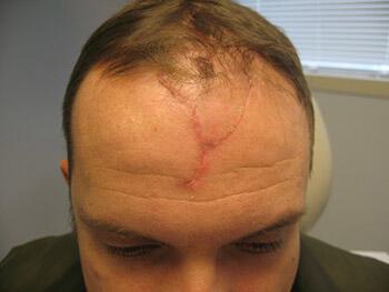 Scar Revision Before & After Image