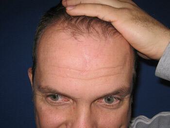 Scar Revision Before & After Image