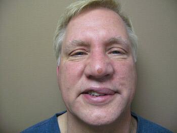 Scar Revision Before & After Image