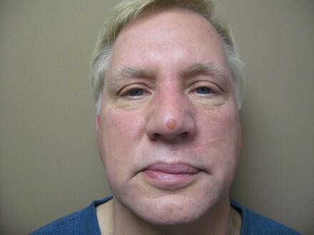 Scar Revision Before & After Image