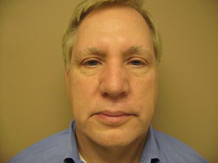 Scar Revision Before & After Image