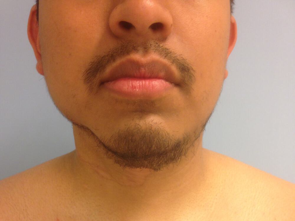 Scar Revision Before & After Image