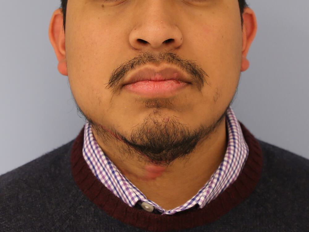 Scar Revision Before & After Image