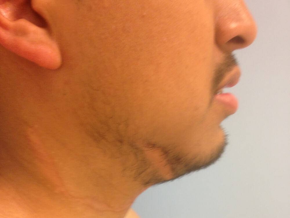 Scar Revision Before & After Image