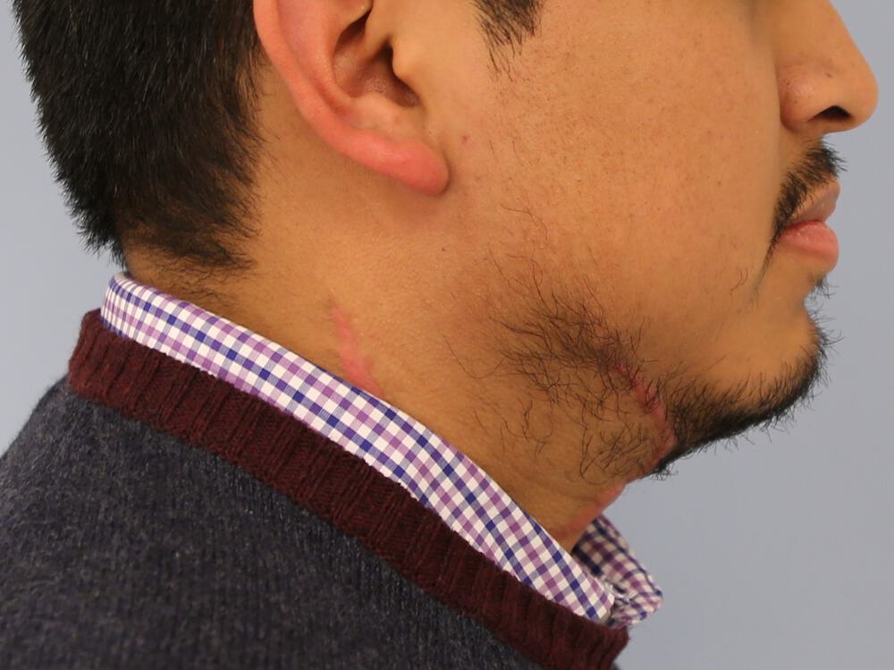 Scar Revision Before & After Image