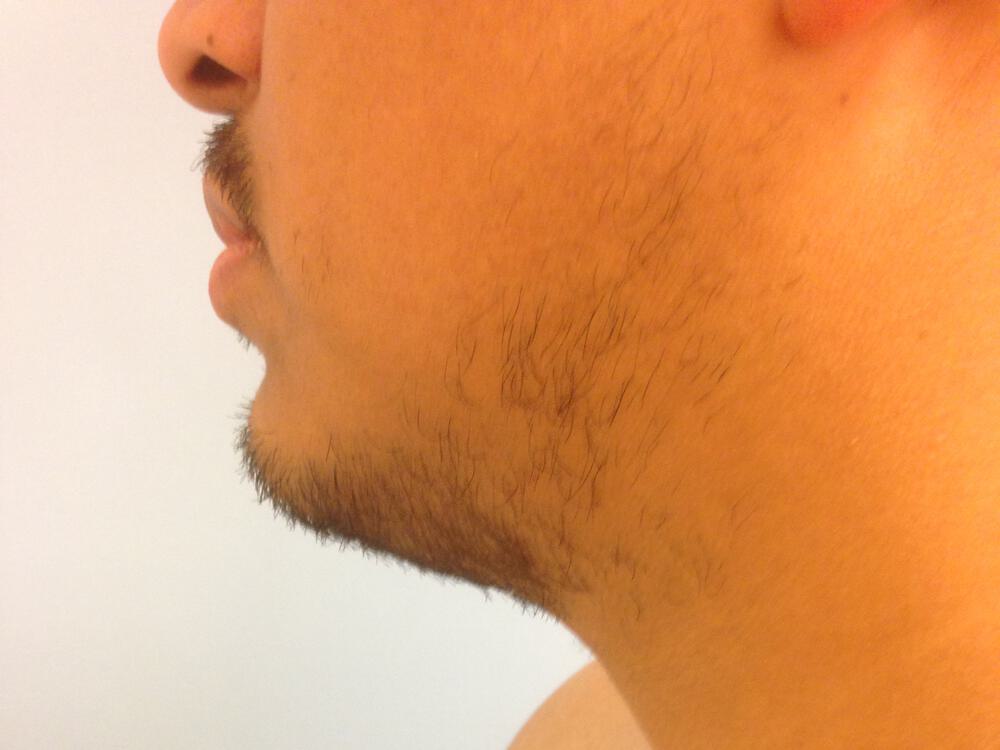 Scar Revision Before & After Image