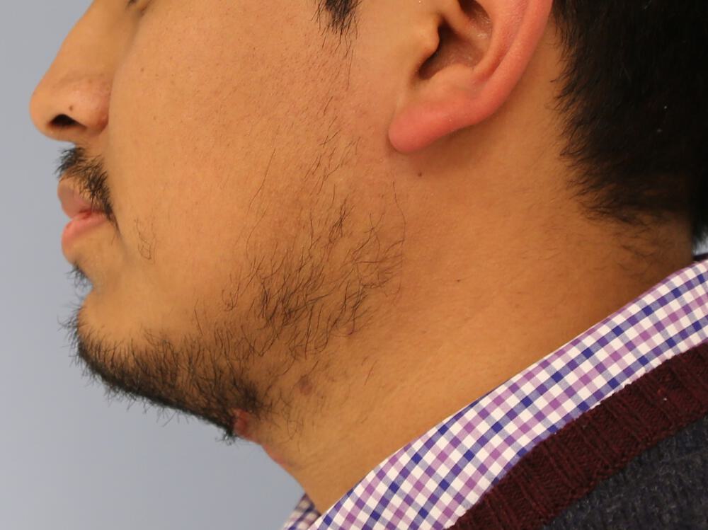 Scar Revision Before & After Image