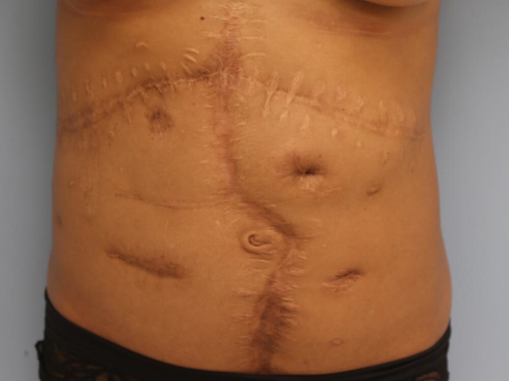 Scar Revision Before & After Image