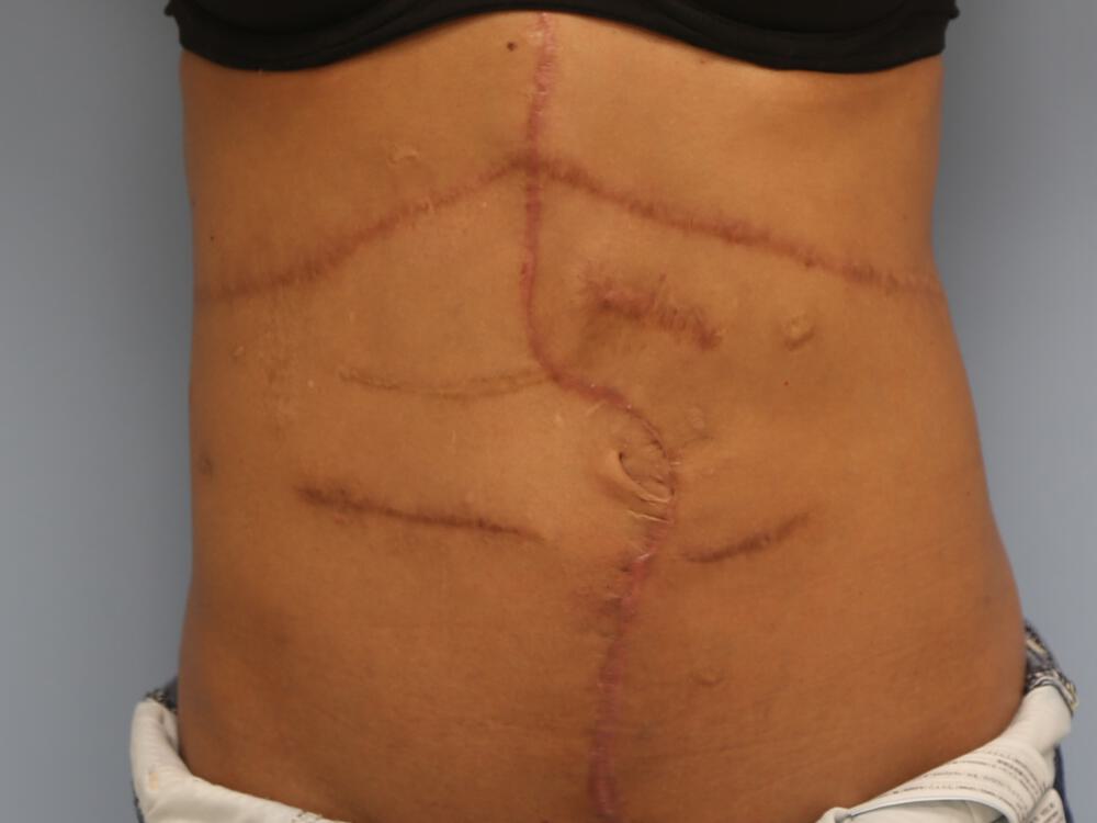 Scar Revision Before & After Image