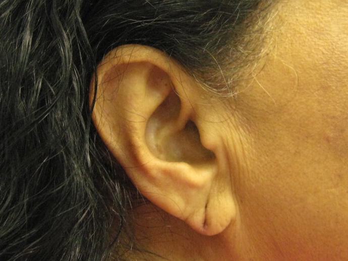 Torn Earlobe Repair Before & After Image