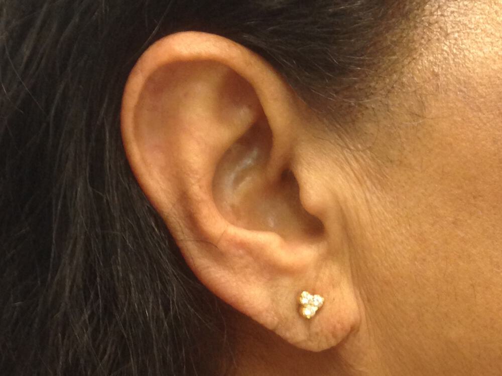 Torn Earlobe Repair Before & After Image