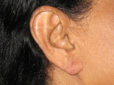 Torn Earlobe Repair Before & After Image