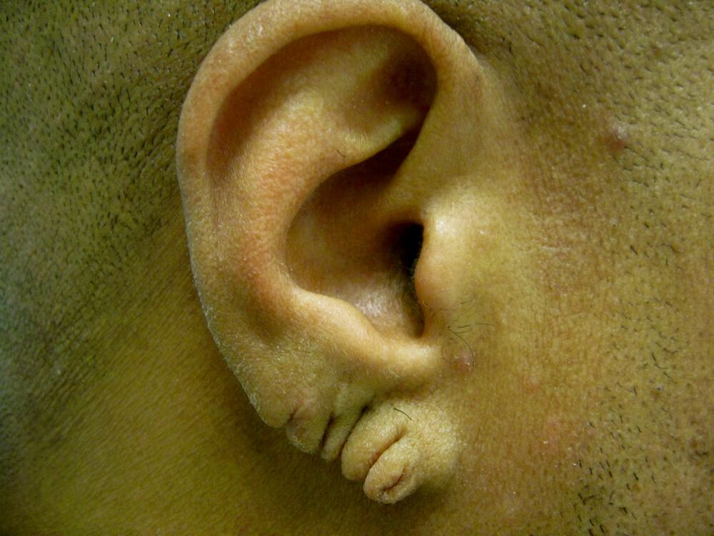 Torn Earlobe Repair Before & After Image