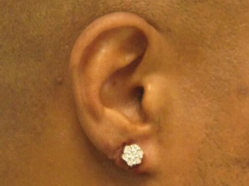 Torn Earlobe Repair Before & After Image