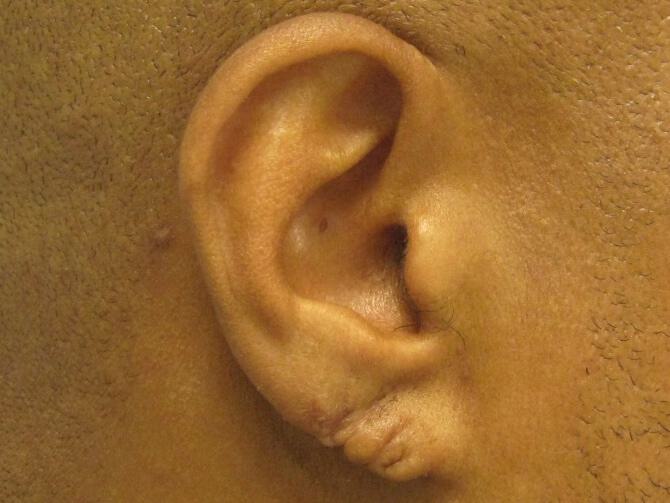 Torn Earlobe Repair Before & After Image