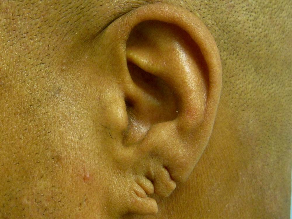 Torn Earlobe Repair Before & After Image