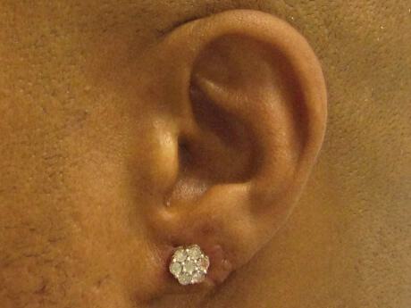 Torn Earlobe Repair Before & After Image