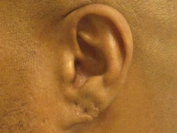 Torn Earlobe Repair Before & After Image