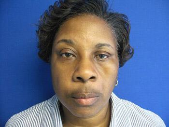 Fat Grafting Before & After Image