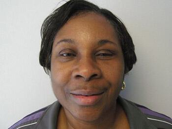 Fat Grafting Before & After Image