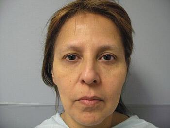 Fat Grafting Before & After Image