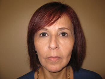 Fat Grafting Before & After Image