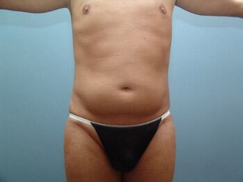 Ab Etching Before & After Image