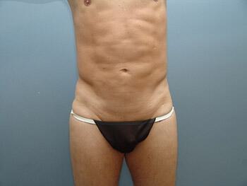 Ab Etching Before & After Image