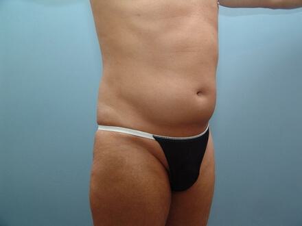 Ab Etching Before & After Image