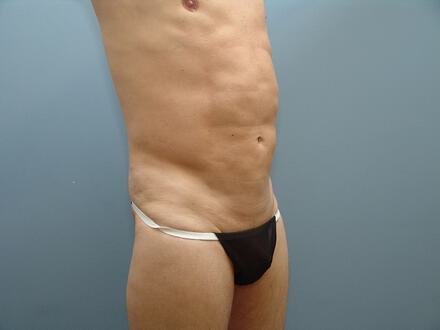 Ab Etching Before & After Image