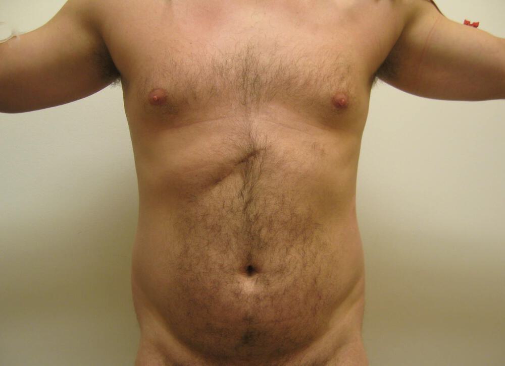 Ab Etching Before & After Image