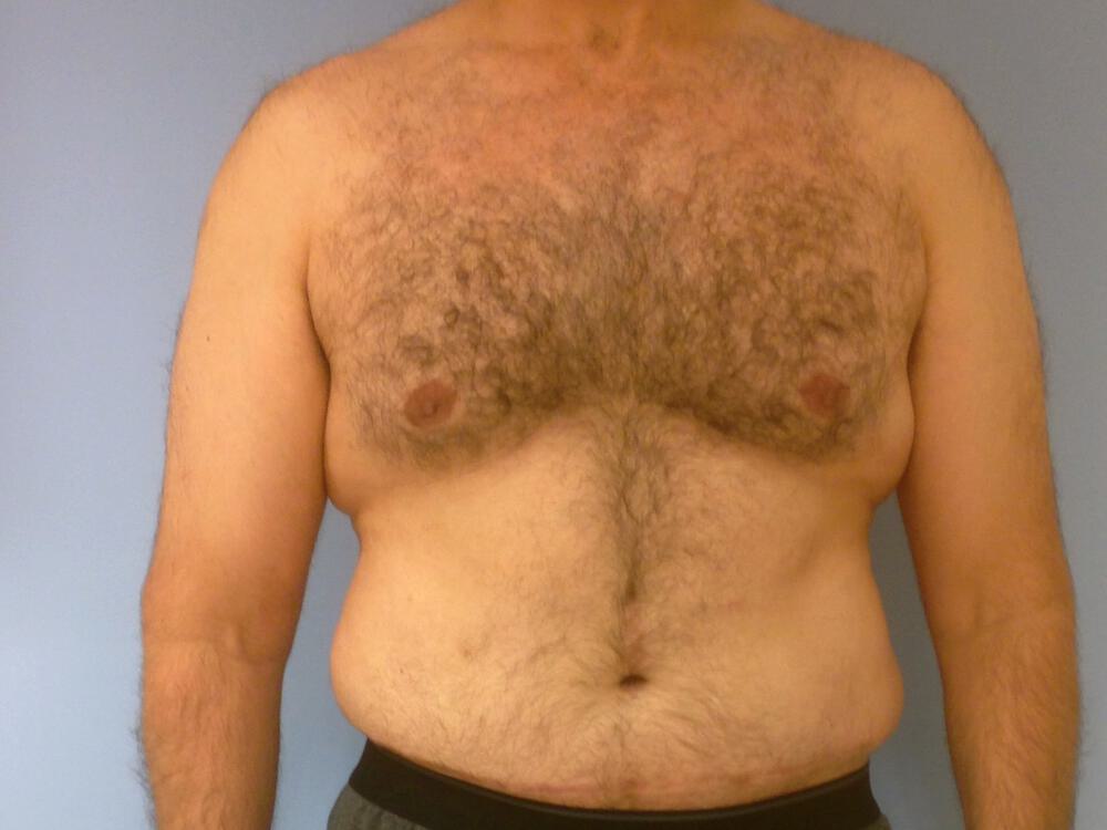 Ab Etching Before & After Image