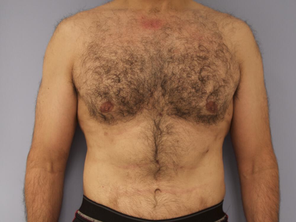 Ab Etching Before & After Image