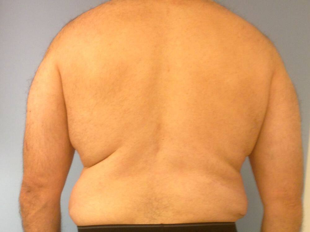 Ab Etching Before & After Image