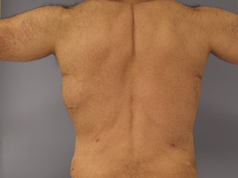 Ab Etching Before & After Image