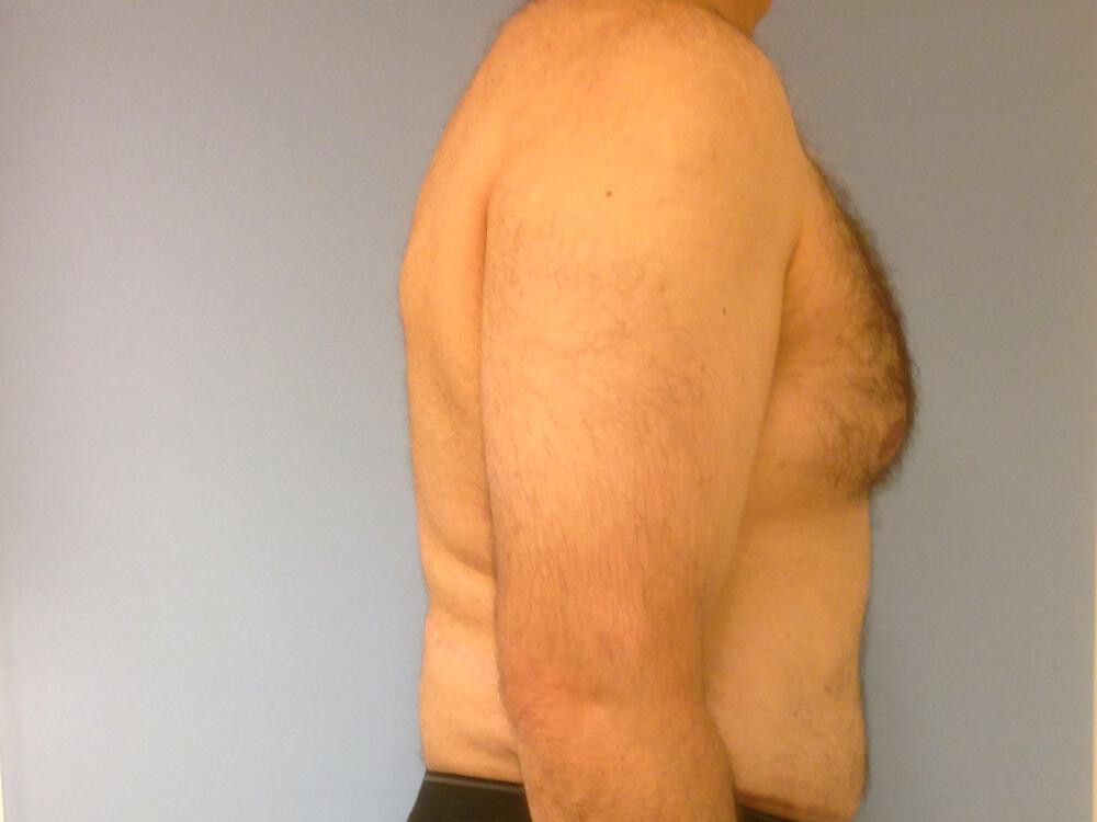 Ab Etching Before & After Image