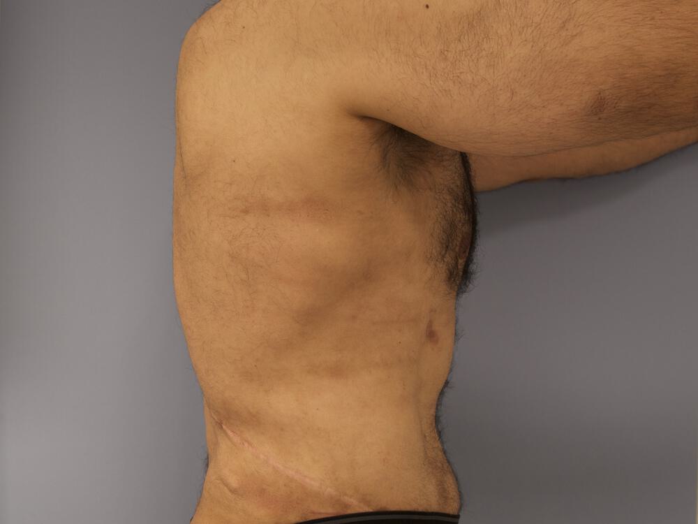 Ab Etching Before & After Image