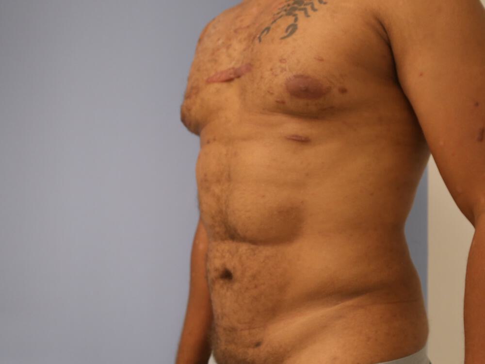 Ab Etching Before & After Image