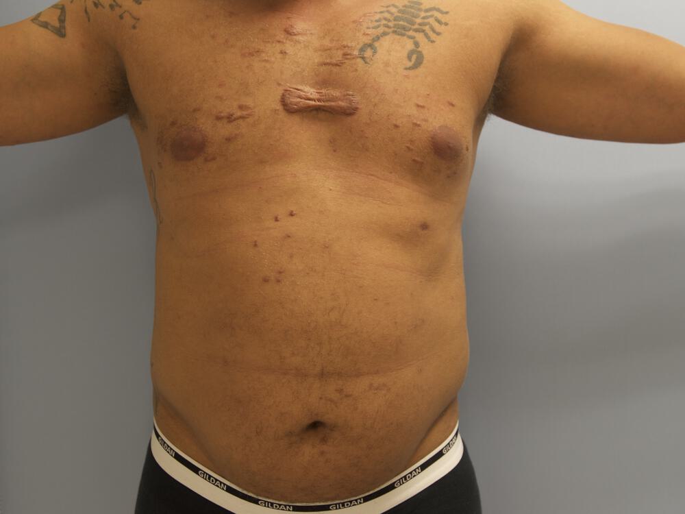 Ab Etching Before & After Image