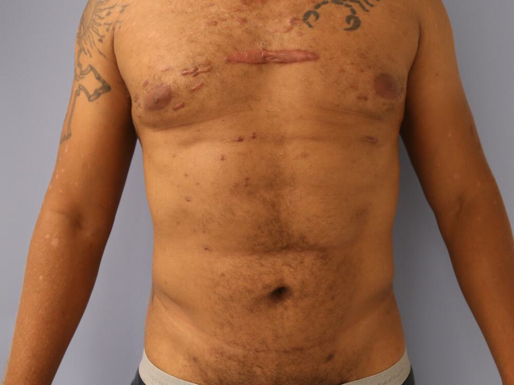 Ab Etching Before & After Image