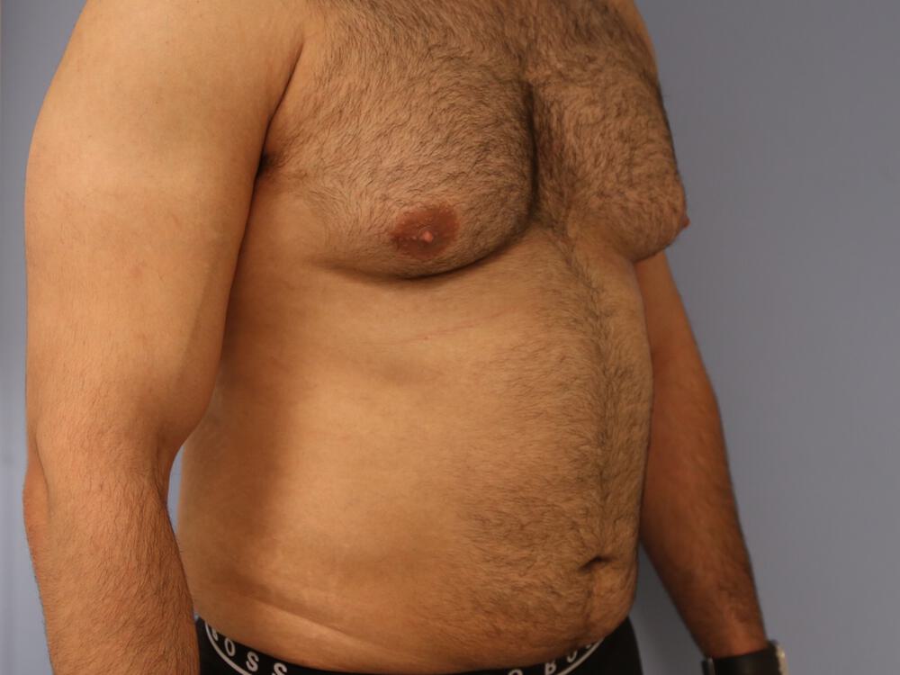 Ab Etching Before & After Image