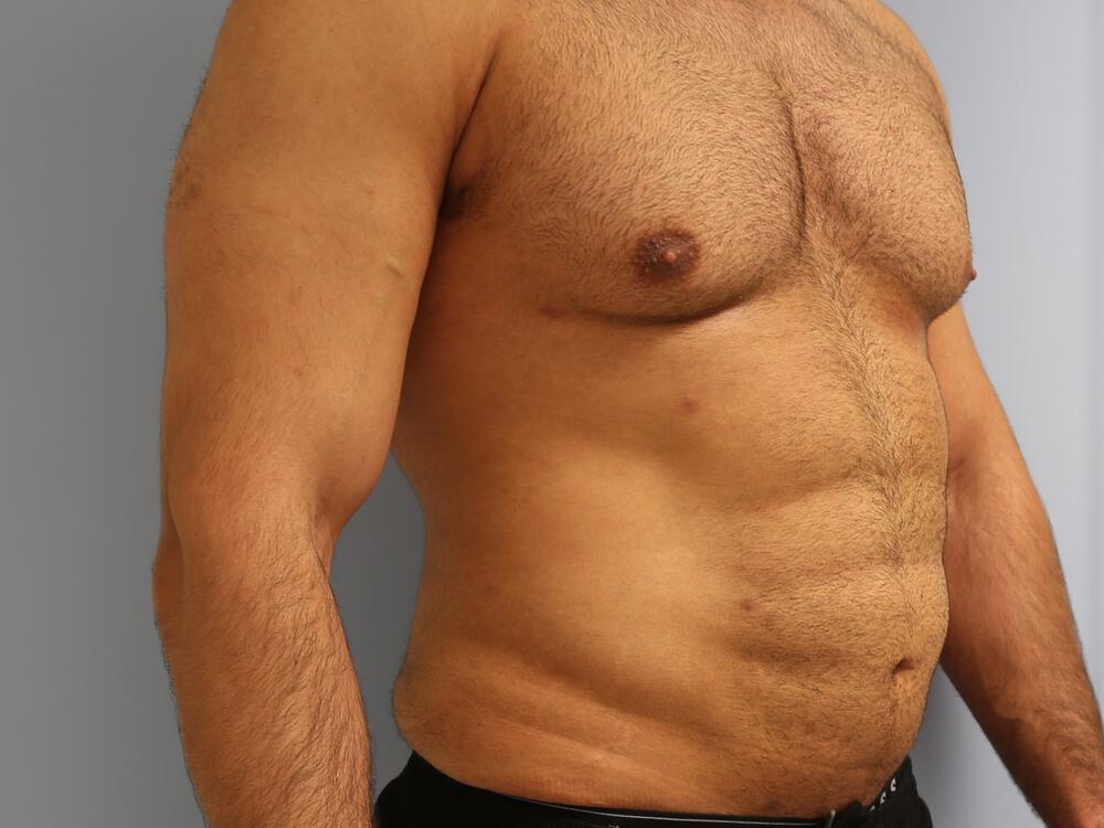 Ab Etching Before & After Image