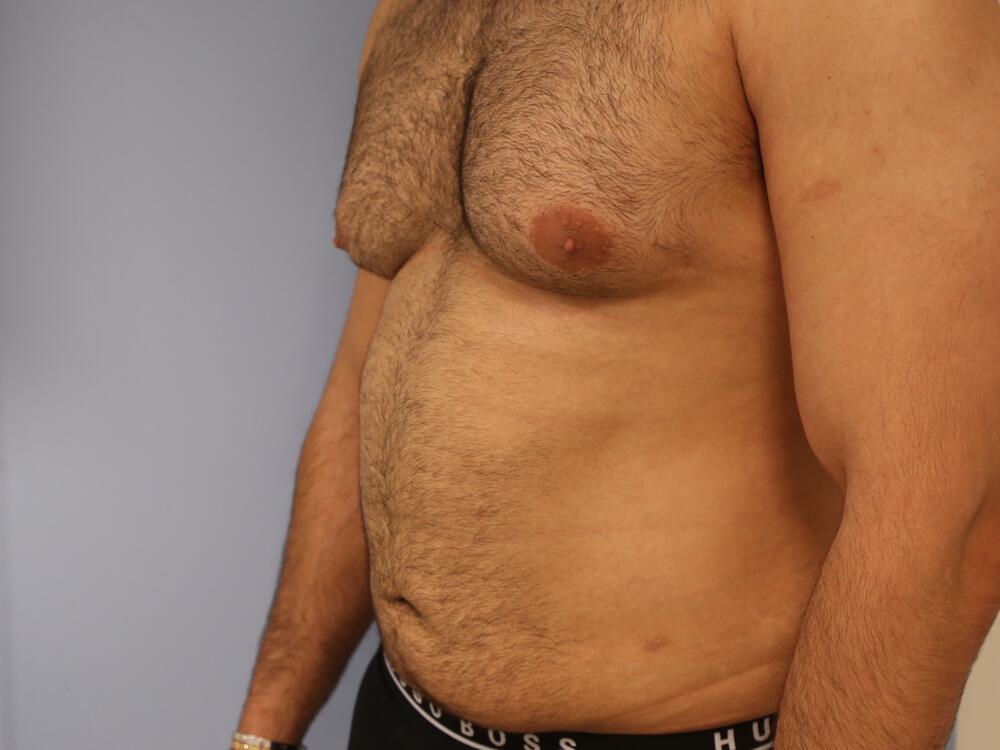 Ab Etching Before & After Image